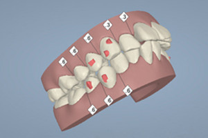 歯の移動を画像と動画で確認できるの画像