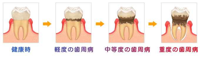 歯周病の進行段階の画像