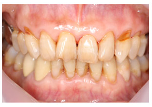 歯周病の進行段階の画像