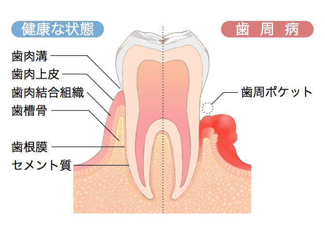 歯周病とはの画像
