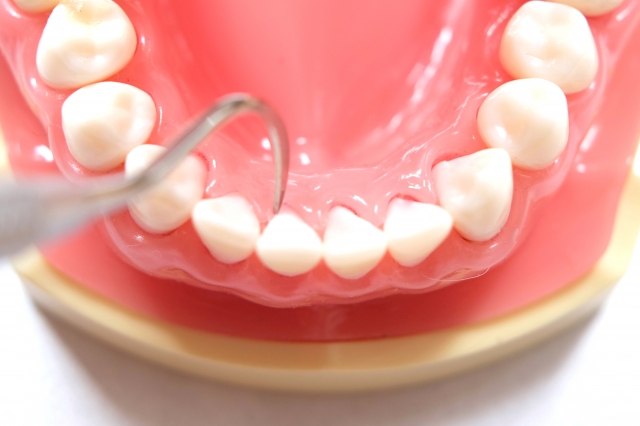 歯石の性質によって異なる固さ