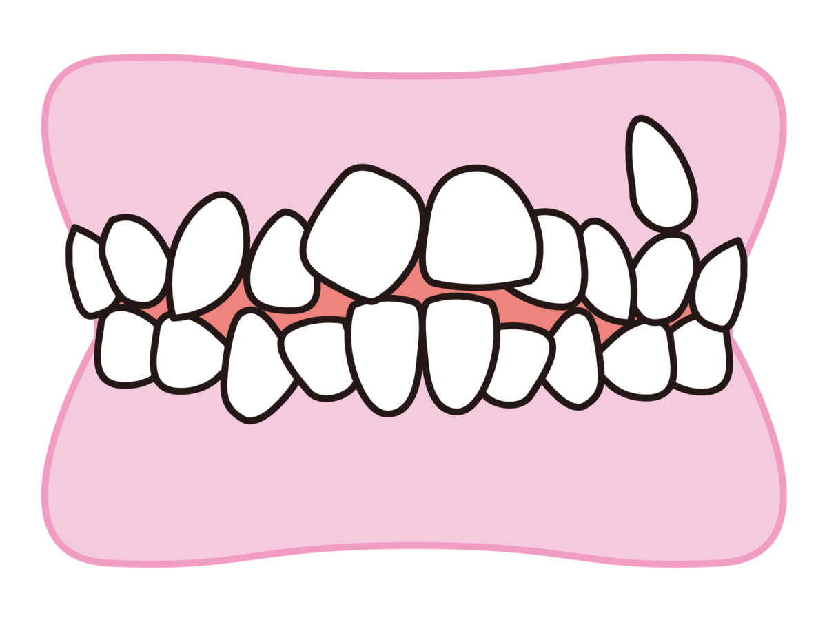 歯並びの悪さと歯周病