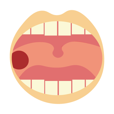 舌癌と口内炎の見分け方