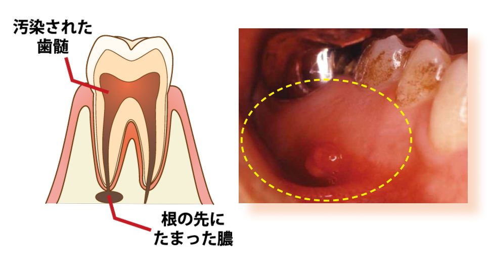 「根尖病巣とは？原因、症状、治療法を解説！」