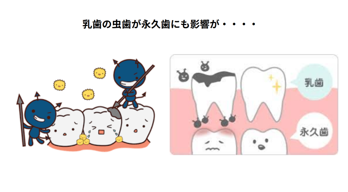 乳歯って抜けるから虫歯になってもいいの？ ～“いずれ抜ける”乳歯こそ、大切に～