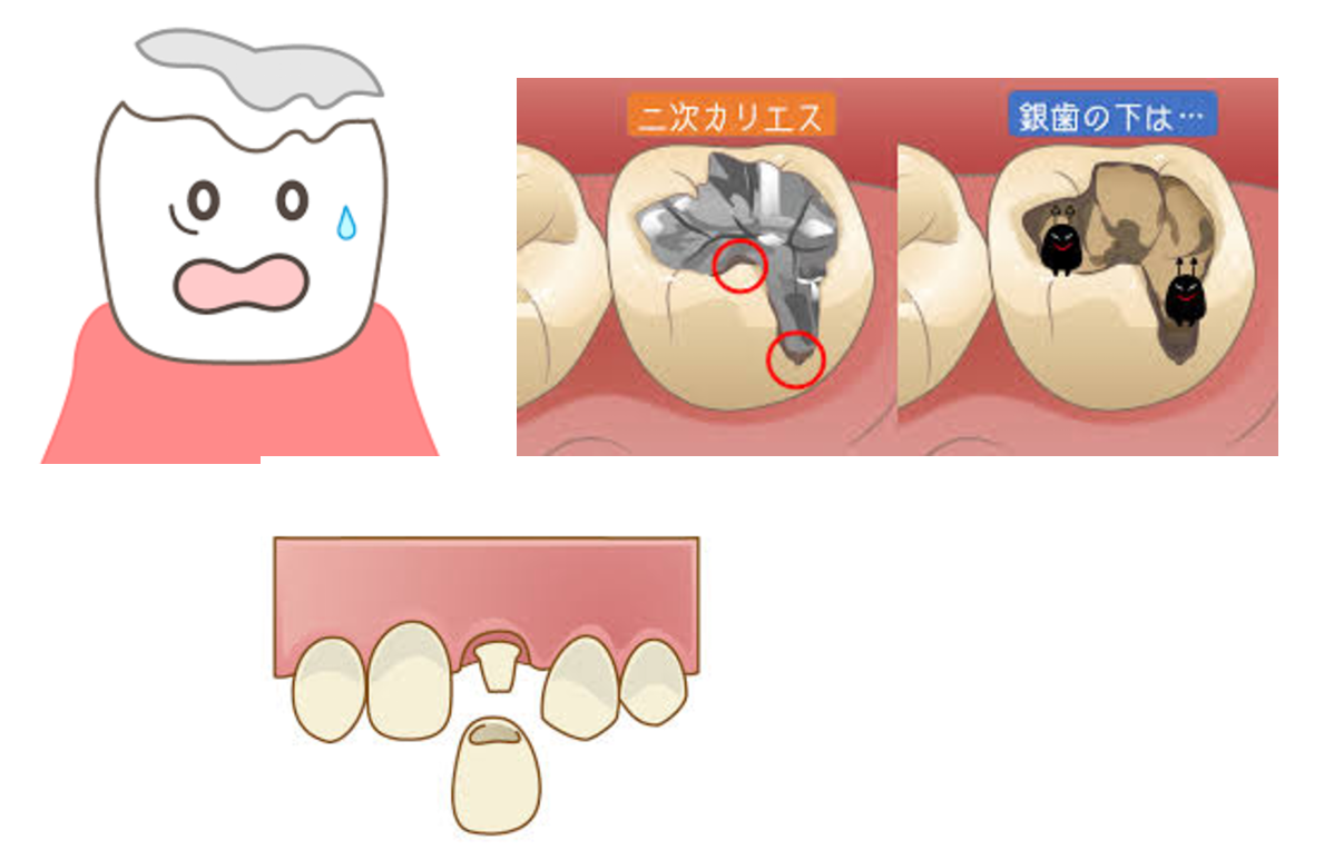 詰め物・被せもの（銀歯・レジン・セラミックなど）が取れた時の原因や注意点、対処法
