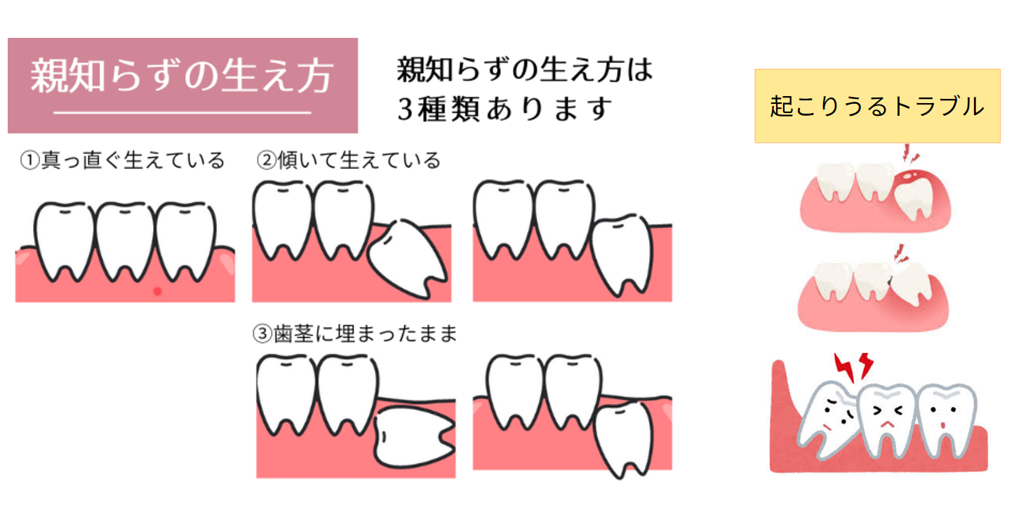 親知らずってなんで生えるの？実は“いらない歯”ってホント？